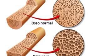 Osteoporose: causas, consequências e cuidados para evitá-la